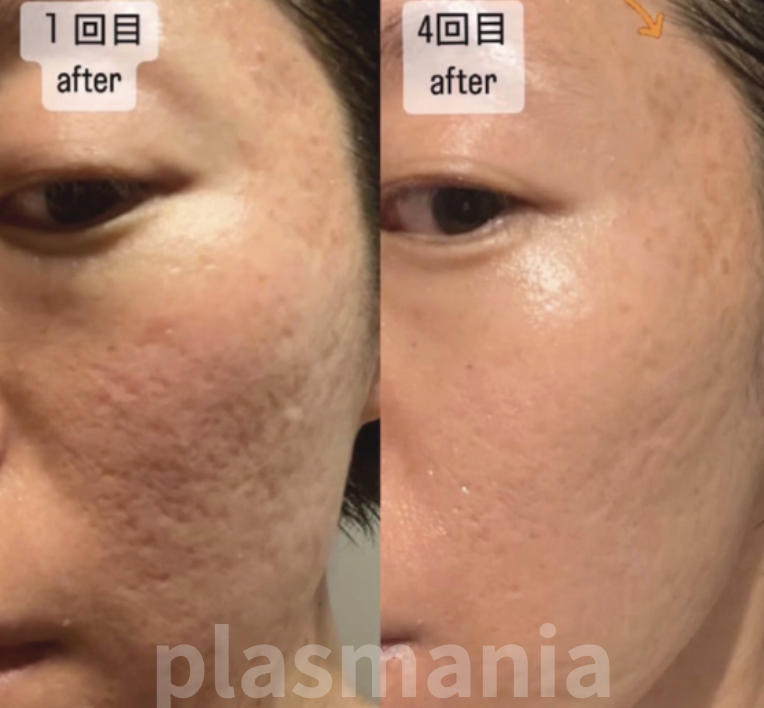 plasmania ビフォアフ 7