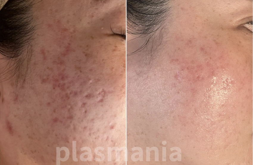 plasmania ビフォアフ 8
