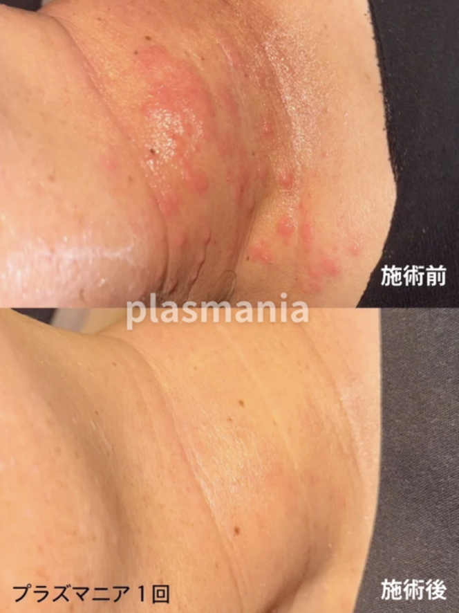 plasmania ビフォアフ 13